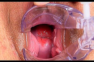 Gyno-4